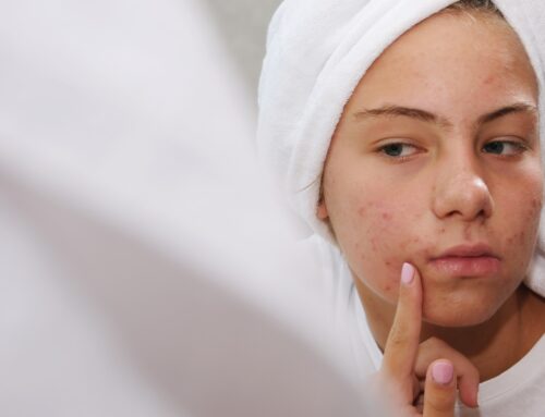 Most Common Causes Of Acne Flare-Ups