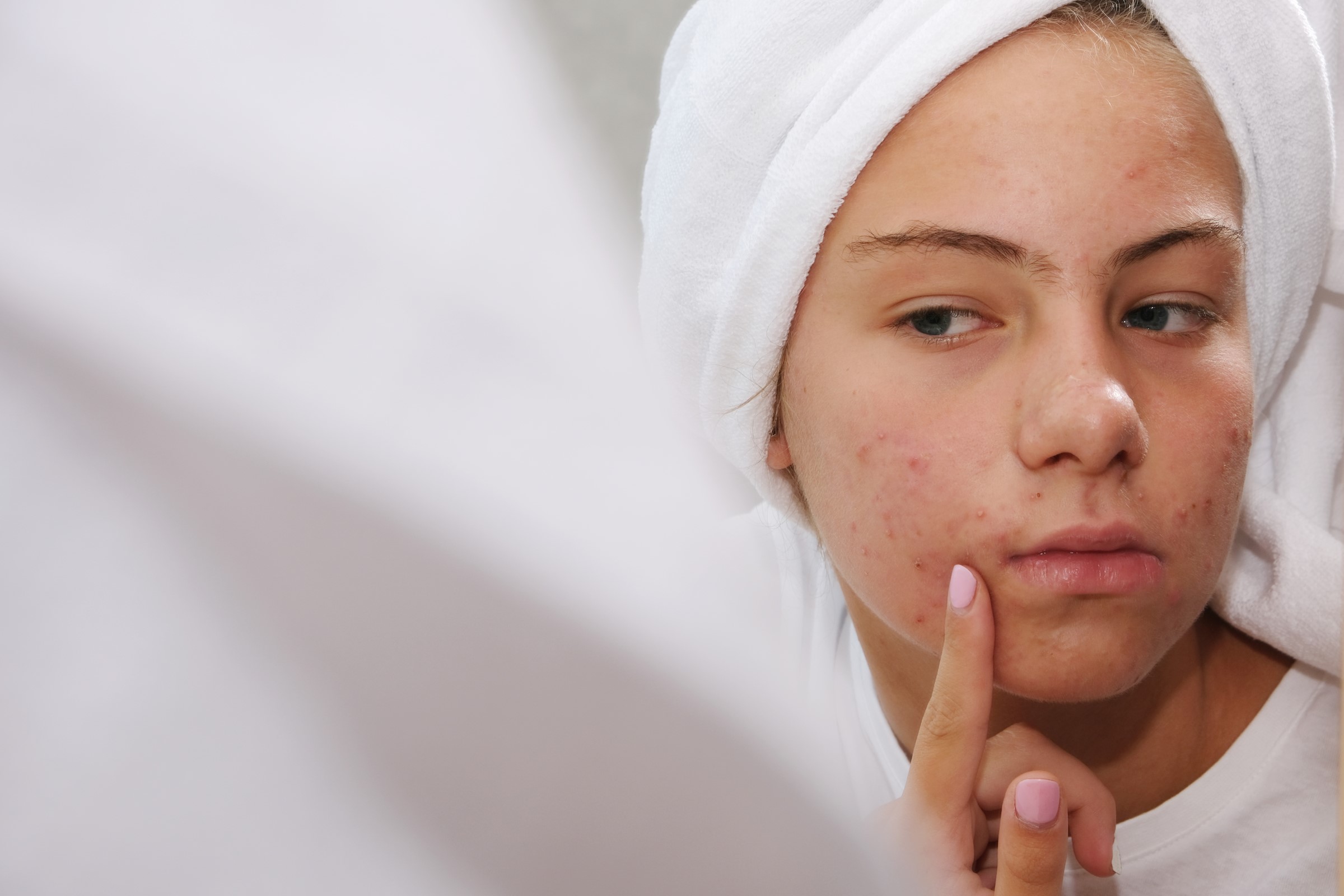 If your acne is flaring up, your brain fog is at an all time high