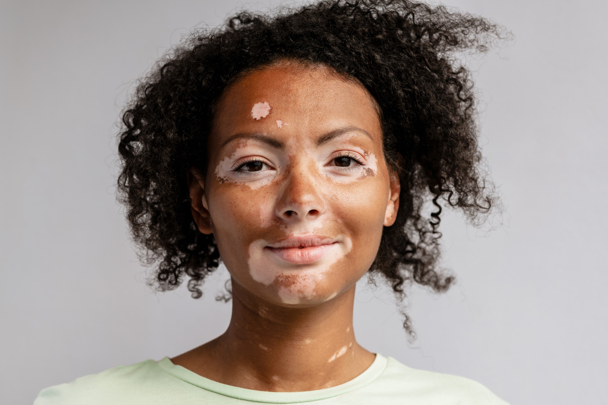 Brown Eyes Vitiligo Face Brown Skin Tone's Code & Price - RblxTrade