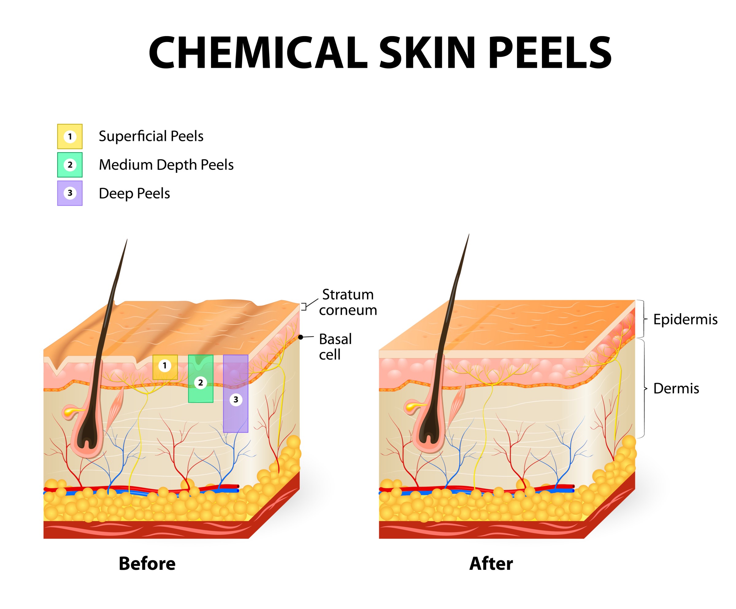 The Peel Deal  Reno Tahoe Dermatology