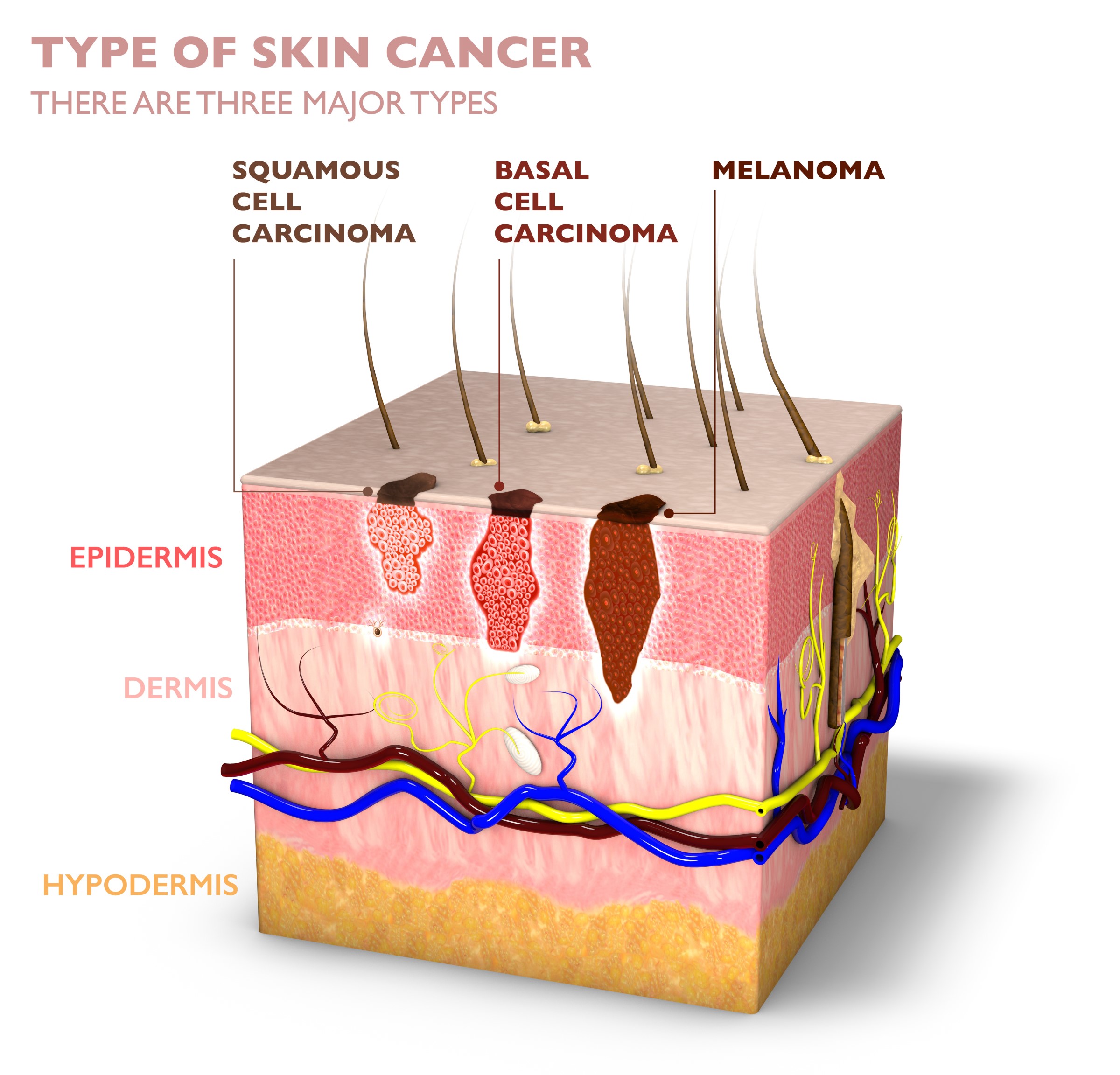 Skin Cancer Reno Tahoe Dermatology Best Reno Dermatologist