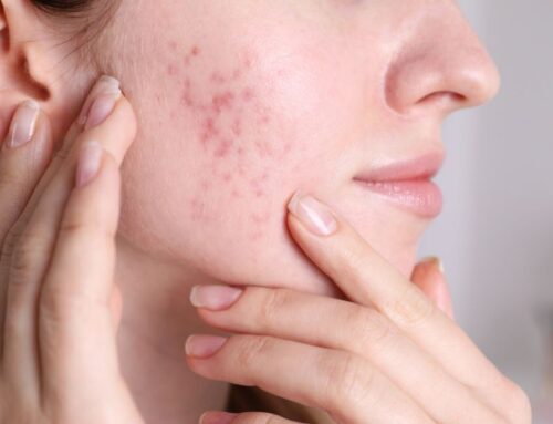 Professional Acne Tips From Reno Tahoe Dermatology