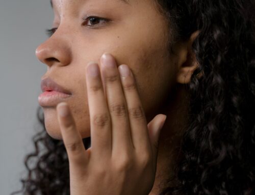 Top 3 Acne Treatments At Reno Tahoe Dermatology: AviClear, Excel V+, & VI Peel